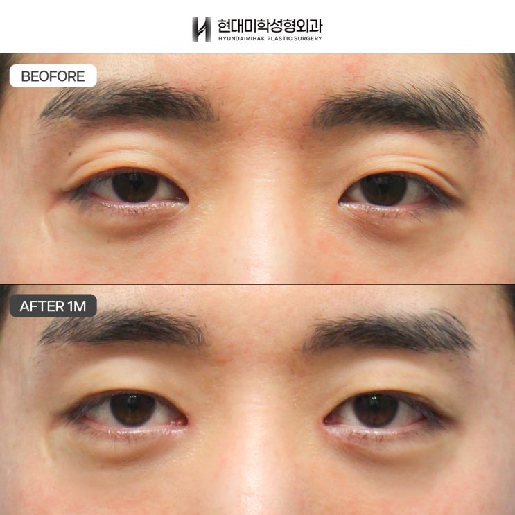 男性の眼瞼下垂矯正の口コミ はっきりとしたビフォーアフターの変化を望むなら