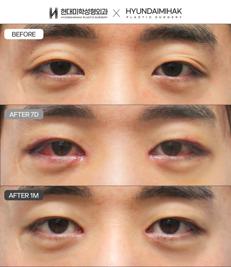 男性の一重目つき矯正で眠そうな印象を変える