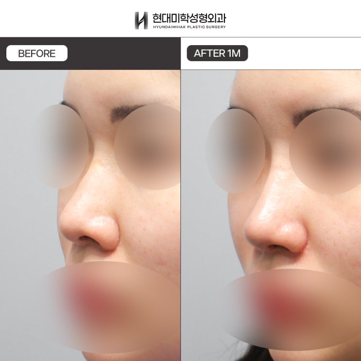 寄贈肋軟骨鼻整形の口コミで語られる寄贈肋軟骨のメリット