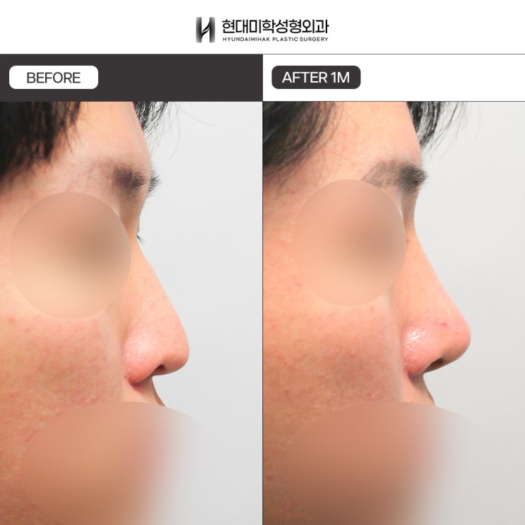 男性鼻整形のビフォーアフター比較分析例