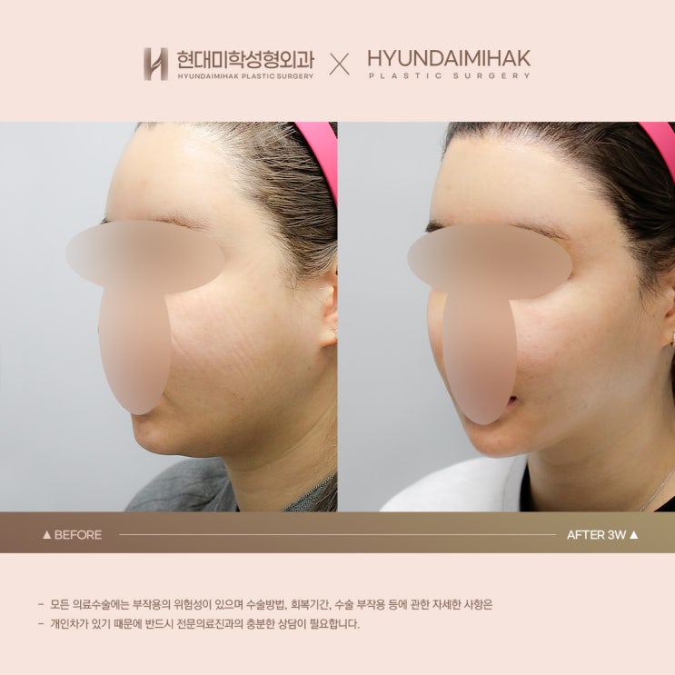 二重あご脂肪吸引のビフォーアフターに見るフェイスライン整え効果