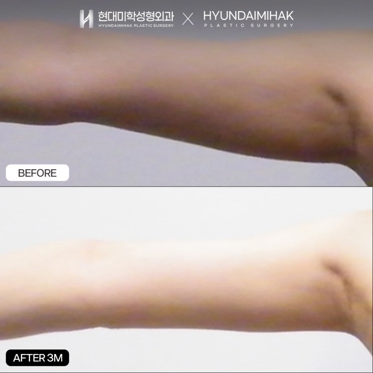 二の腕脂肪吸引手術で、すっきり細い腕のラインを早く完成させる方法
