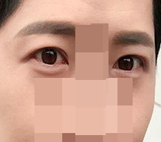 男の二重手術レビューです ㅋㅋㅋ