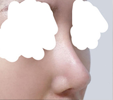 Blunt nose improvement