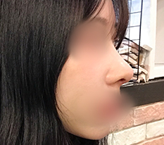 顔に立体感が出ました笑