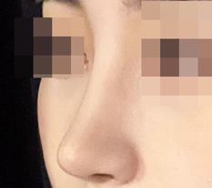I recommend 現代美学整形外科 to anyone who wants pretty nose surgery!!!!!