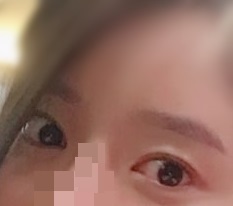 眼瞼下垂矯正に大満足です！