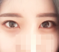 目尻切開とたれ目形成しました!!!!