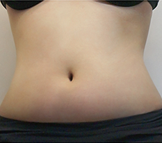 I worried about abdominal liposuction for nothing lol