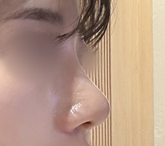わし鼻をやっつけてきました