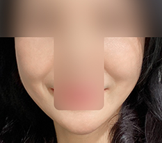 糸リフトに満足しています