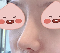 鼻の再手術からついに6ヶ月目に入りました ㅎㅎ