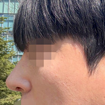 男性のわし鼻整形