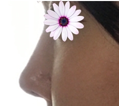 I got revision rhinoplasty~