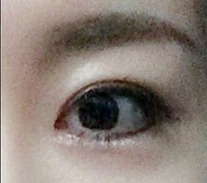 目の再手術、大成功 ^^