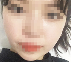 頬骨縮小