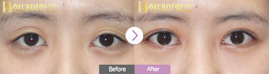 目の切開再手術、眼瞼下垂矯正、目尻切開、たれ目形成