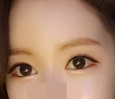目の切開をして可愛くなりました