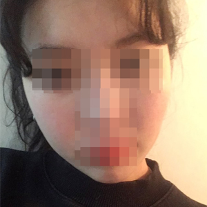頬骨一つ手術しただけなのに