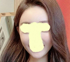 頬骨手術から5ヶ月が経った感想をシェアします~！