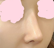 鼻の手術をしたことをあちこちで自慢しています ㅎㅎ
