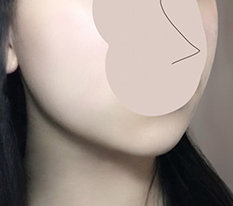 糸リフト効果ばっちりです