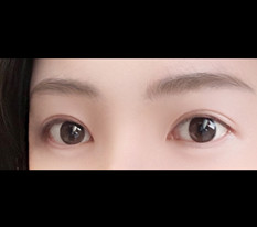 左右差のあるラインを低くする二重再手術