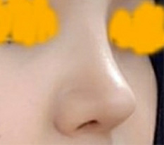 My round, blunt nose became a high, sharp nose haha