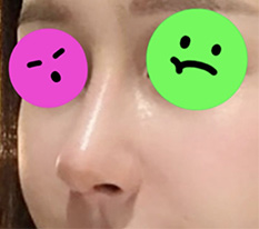 コ手術から1ヶ月が経って完全に満足中^^