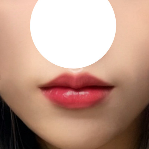 現代美学整形外科で唇整形をしました
