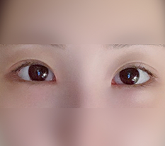 デュアル切開ってこういうことだったんですね 笑