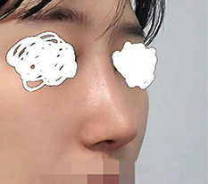低い鼻のストレスからもう解放されて本当に良かったです :)