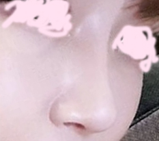 鼻の再手術レビューです~