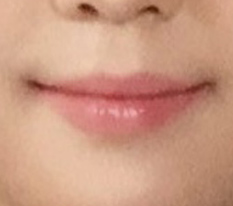 I took an ID photo after mouth-corner surgery
