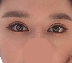 目の再手術1か月目 笑 このくらいなら成功ですよね？？^^