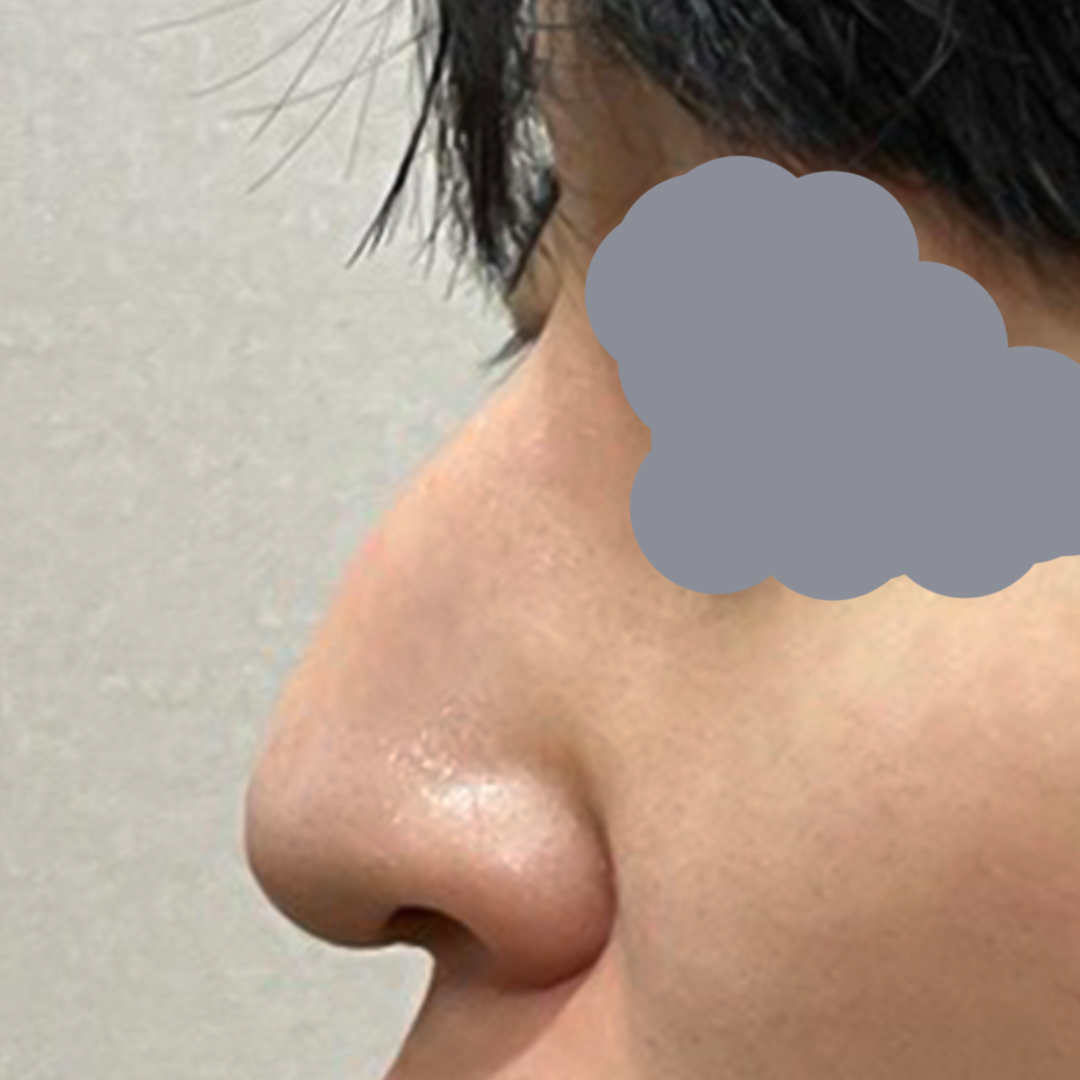 男性の鷲鼻手術