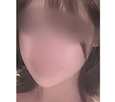 リフトアップに大満足 XD