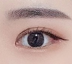 腫れがすごく引いて自然になりました