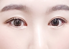 目の整形は現代美学でゴーゴー~