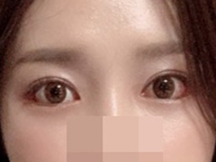 目の手術しましたよ~♥