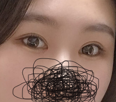 They really deserve the nickname canthoplasty specialist~ 現代美学整形外科 is the best!
