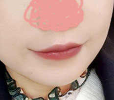 口角の手術後、2ヶ月レビューを投稿していましたが、3ヶ月になったので3ヶ月レビューも書いてみます><