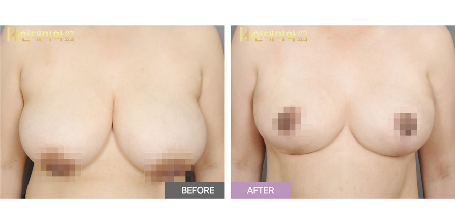 乳房縮小手術
