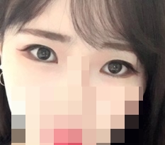 Totally satisfied with 現代美学整形外科 eye-shape correction♥