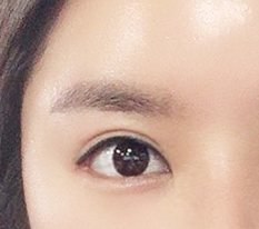I had revision double eyelid surgery!