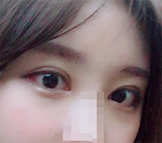 二重まぶた手術、大満足!!