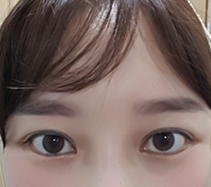 テンミニット埋没の当日写真が不思議でアップします〜