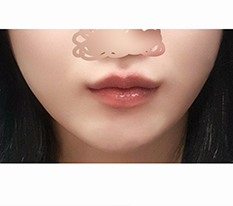 ボトックスの代わりに口角挙上手術