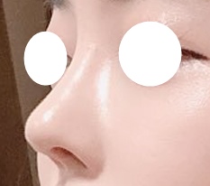 鼻整形のおかげできれいになったとすごく言われています