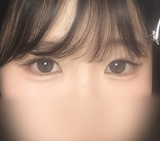 目尻・下まぶた切開ですっきり